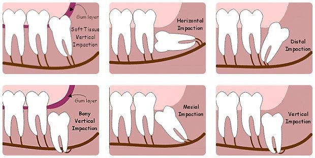 Những trường hợp răng khôn cần nhổ bỏ