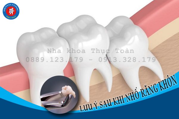 Lưu ý chăm sóc sau khi nhổ răng khôn