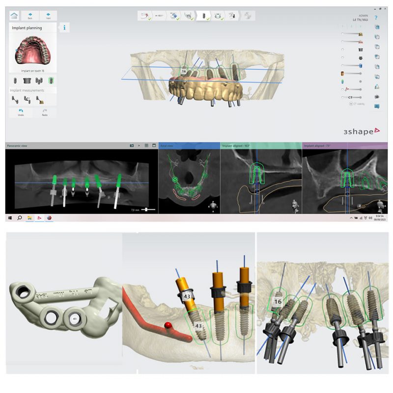 trồng răng implant tại bắc ninh